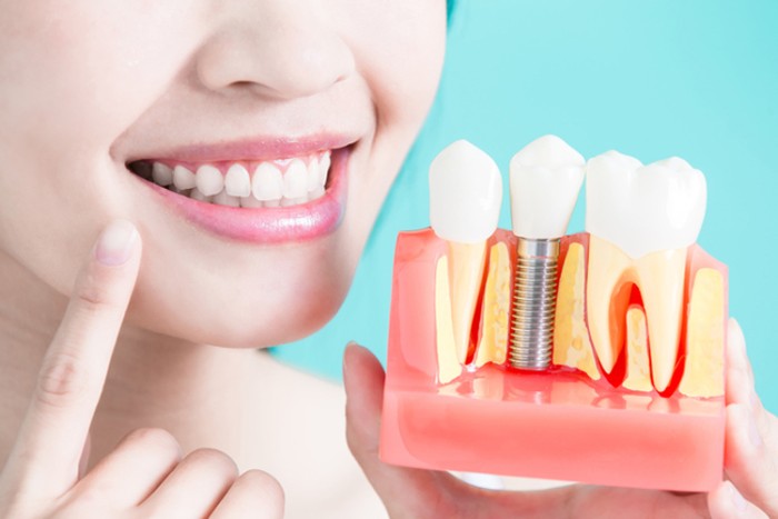 CẤY GHÉP RĂNG IMPLANT