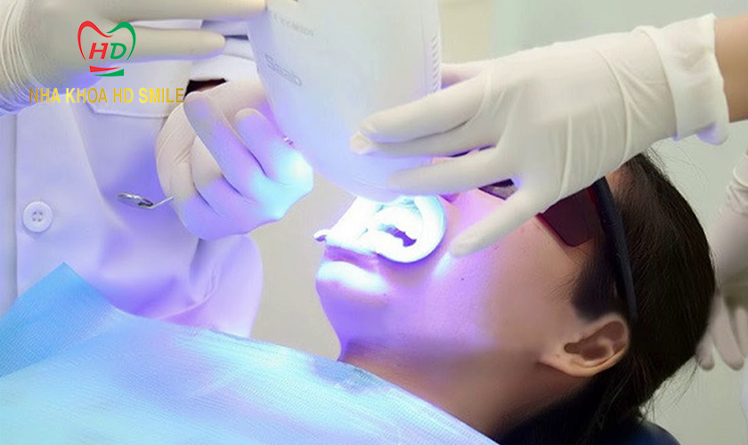 418 tay trang rang laser whitening va hieu qua mang lai 1