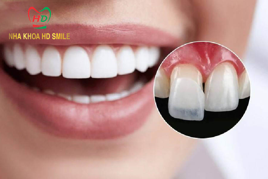 dan su veneer giup khac phuc rang cua thua