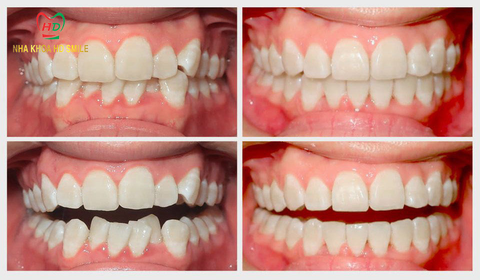 nieng rang trong suot invisalign1
