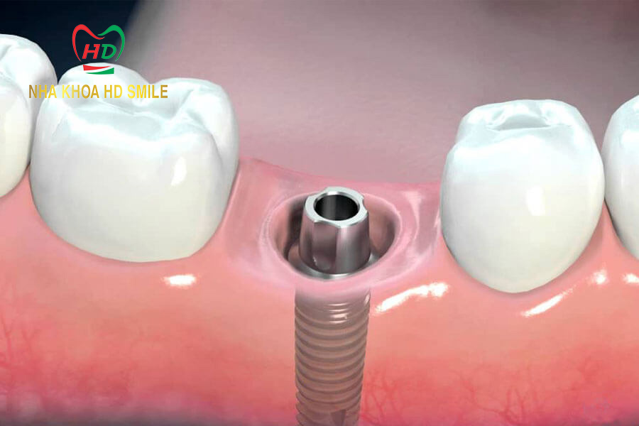 qua trinh trong rang implant co dau khong 5