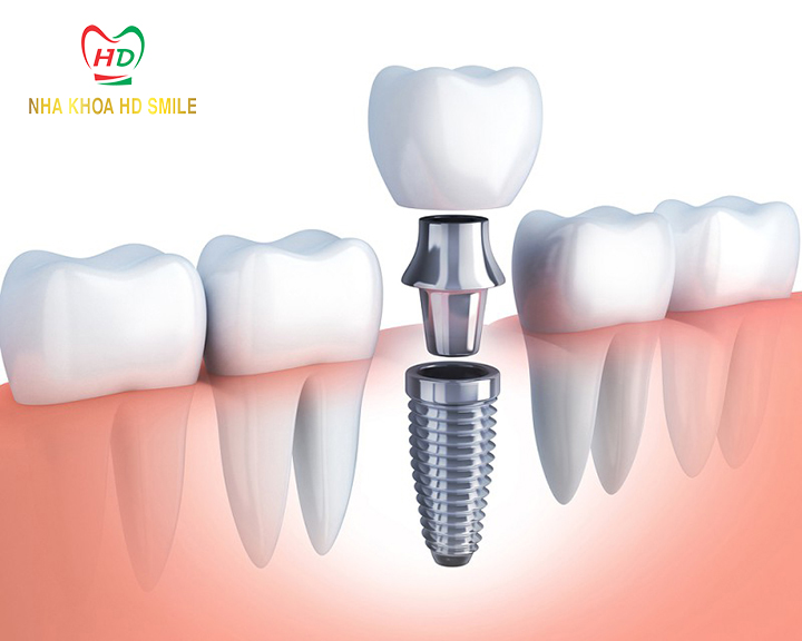 trong rang cam ghep rang implant