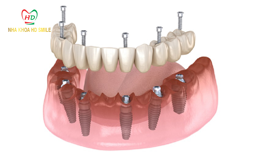 trong rang implant all on 6